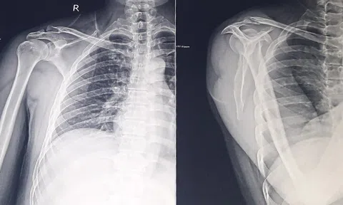 Người đàn ông ngã gãy xương vai vì thói quen hút thuốc lào vào sáng sớm