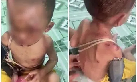 Vụ bé trai nghi bị bạo hành: Hội Bảo vệ quyền trẻ em TP.HCM lên tiếng