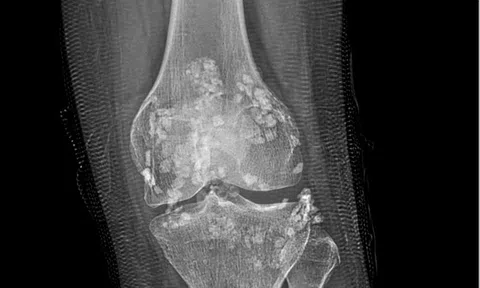 Tin tức đời sống ngày 20/4: Gắp hơn 100 viên sỏi ra khỏi khớp gối của người phụ nữ