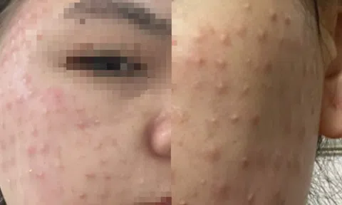 Mặt chi chít nốt sần trắng sau 2 tuần tiêm chất làm đẹp da miễn phí