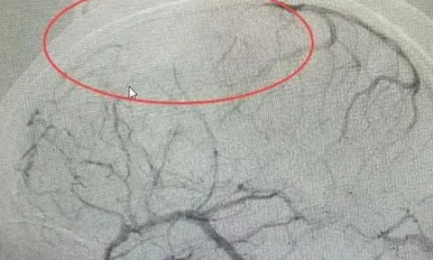 Cô gái nhập viện do tắc mạch máu não vì thói quen dễ gặp ở người trẻ