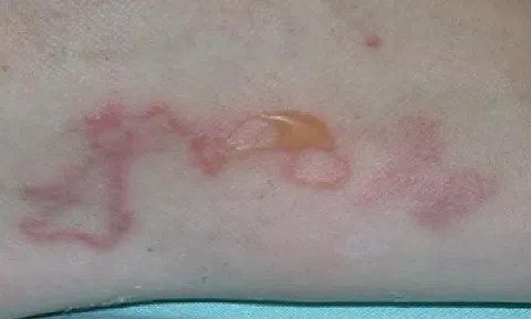 Tin tức đời sống ngày 2/5: Người phụ nữ bị ngứa 4 năm mới phát hiện nhiễm giun đũa chó mèo