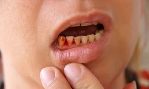 Bị mắc sốt xuất huyết nên ăn gì, kiêng gì?