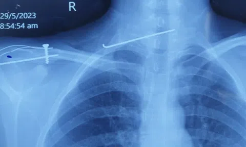 Tin tức đời sống ngày 7/6: Chiếc kim dài 8cm lạc trôi vào cột sống cổ của cô gái