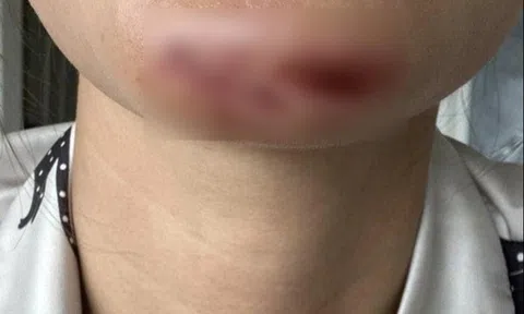 Tình trạng hiện tại của Minh Tú sau khi phải khâu 10 mũi