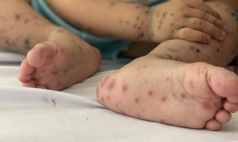 6 tháng đầu năm 2023 cả nước ghi nhận gần 13.000 ca mắc tay chân miệng