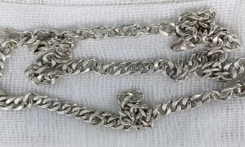 Tin tức đời sống ngày 11/7: Cứu bé gái 6 tuổi nuốt sợi dây chuyền dài vào bụng