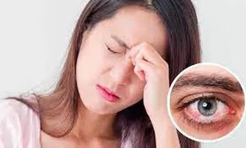 Cẩn trọng với bệnh đau mắt đỏ khi thời tiết giao mùa