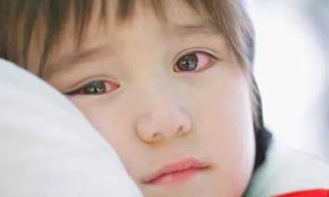 Cảnh báo bệnh về mắt cực dễ lây mạnh trong mùa hè, ai cũng nên biết cách xử trí