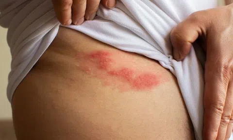 Cảnh báo: Biến chứng nguy hiểm từ Zona thần kinh