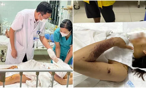 Điện thoại đang sạc phát nổ khiến người phụ nữ bị vỡ nhãn cầu, chi chít hàng trăm vết thương