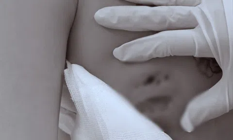 Cô gái 26 tuổi gặp họa sau khi tiêm filler nâng vòng 1