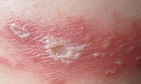Virus thủy đậu tồn tại trong cơ thể người có thể gây ra bệnh zona