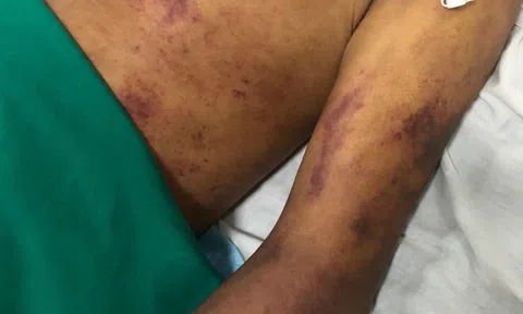 Ăn thịt lợn ốm, người đàn ông nhập viện trong tình trạng sốc nhiễm khuẩn, suy đa tạng