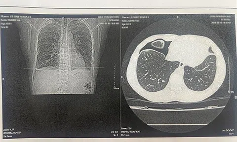 Người đàn ông suýt mất mạng sau khi ăn món gỏi cua đặc sản