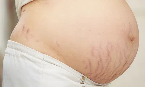 Giải quyết rạn da cực nhanh chỉ bằng một vài thao tác nhỏ