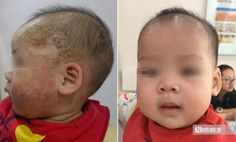 Trị viêm da cơ địa bằng tắm lá, bé 8 tháng tuổi biến chứng nặng