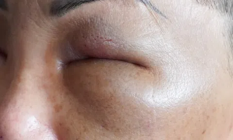 Nửa đêm cấp cứu vì vào nhà nghỉ tiêm filler làm đẹp giá rẻ
