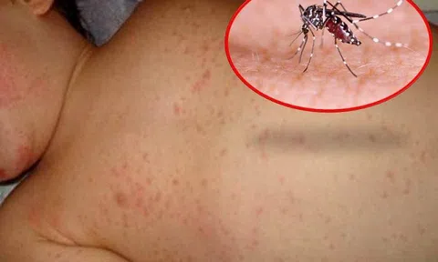 Số ca sốt xuất huyết tại Hà Nội tăng dựng đứng, lên hơn 2.000 ca/tuần