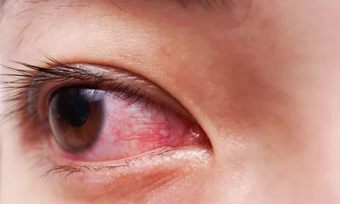 Giải đáp câu hỏi: Nhìn nhau có lây bệnh đau mắt đỏ không?