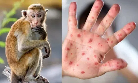 Ghi nhận 2 ca đậu mùa khỉ, Bộ Y tế đề nghị xác định nguồn lây