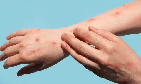 Chuyên gia nhận định gì về nguy cơ lây lan bệnh đậu mùa khỉ?