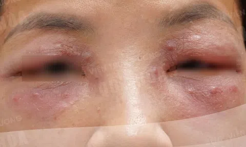 Tiêm meso giá rẻ tại spa, người phụ nữ 30 tuổi phải "cầu cứu" bệnh viện
