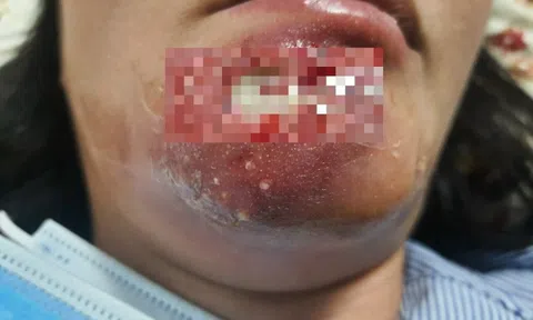 Nghe người quen mách "mẹo hay", người phụ nữ biến dạng vùng cằm