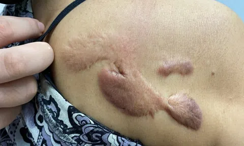 Người phụ nữ gánh tật vì "cú lừa" của spa