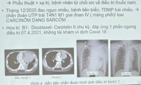 Phát hiện bệnh u phổi hiếm gặp ở người trẻ