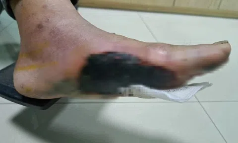 Nam bệnh nhân loét bàn chân do thói quen thường gặp