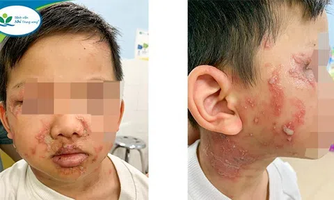 Độc tố kiến ba khoang mạnh gấp 12-15 lần rắn hổ mang, bác sĩ hướng dẫn cách xử trí