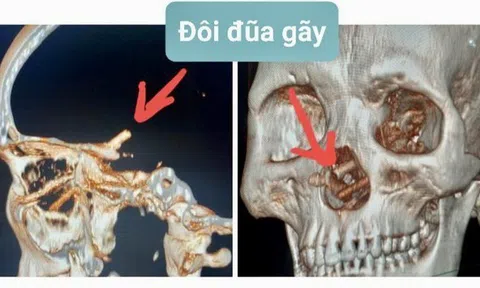 Đau đầu, người đàn ông đến bệnh viện mới biết bị đũa đâm từ mũi lên não