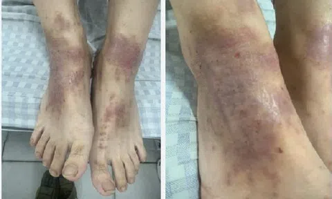 Tắm loại lá quen thuộc, bệnh nhân da thêm xù xì phải vào viện gấp