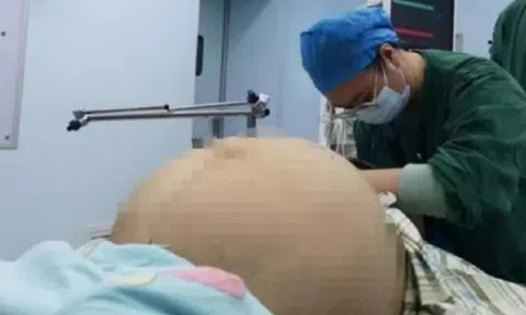 Nghĩ mình béo bụng dưới, nào ngờ cô gái mang khối u "khủng" nặng 21kg
