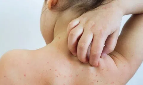 Ghi nhận ca đầu tiên nhiễm rubella ở Hà Nội năm 2024