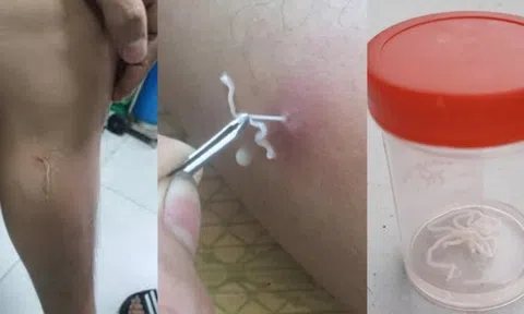 Loại ký sinh trùng chỉ có ở châu Âu bỗng phát hiện ở Việt Nam: Chúng nguy hiểm thế nào?