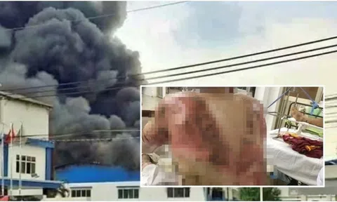 Vụ cháy lớn ở Đồng Nai: Nam công nhân bỏng nặng, khả năng phải ghép da