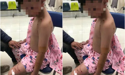 Bé trai 10 tuổi bị chó tấn công, trên người có nhiều vết thương