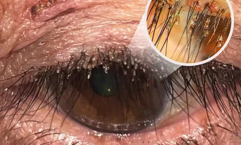 Ngứa mắt kéo dài, người phụ nữ đi khám phát hiện rận mu bám đầy lông mi