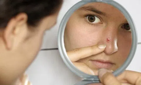 Mụn mủ sưng đỏ cũng xẹp lép với những nguyên liệu chưa đến 10 ngàn đồng