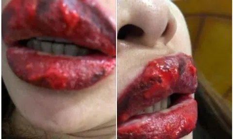 Đi xăm môi trái tim căng mọng, cô gái đau đớn khi nhận lại đôi môi sưng tều, mưng mủ