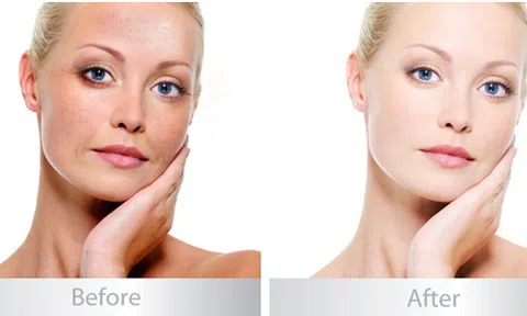 Cách trị nám giúp chị em \"lột xác\" sau sinh