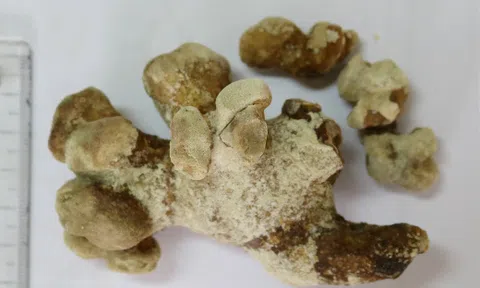 Khối sỏi san hô lớn trong thận cụ ông 71 tuổi