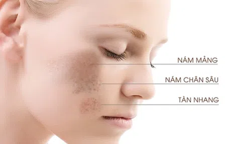 Nguyên tắc 4 “không” giúp bạn đơn giản hóa hành trình trị nám và tàn nhang