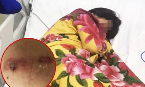 Đang ngủ, bé gái bị rết chui vào giường cắn trọng thương