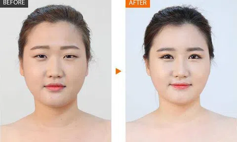 Cắt mí mắt làm đẹp liệu có nguy hiểm không?