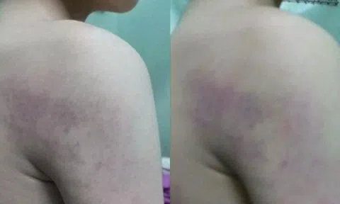 Giáo viên ở Hà Nội bị phụ huynh tố đánh học sinh lớp 1 thâm tím người