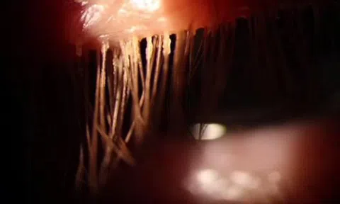 Ham nối mi giả làm đẹp, hàng loạt phụ nữ phải nhập viện vì bọ ve `làm tổ`