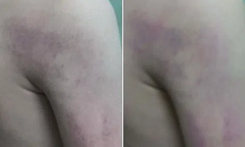 Cô giáo đánh học sinh bầm tím người tại Hà Nội bị kỉ luật